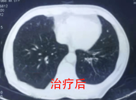 治疗后