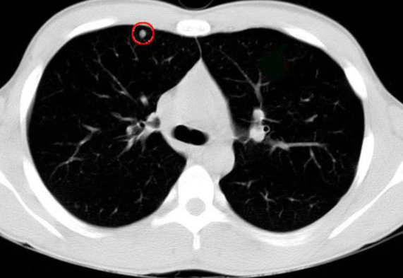 肺部结节形成原因