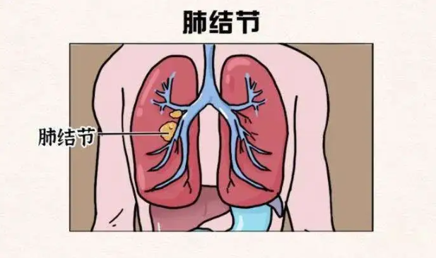 肺部有结节是怎么回事？要紧吗？