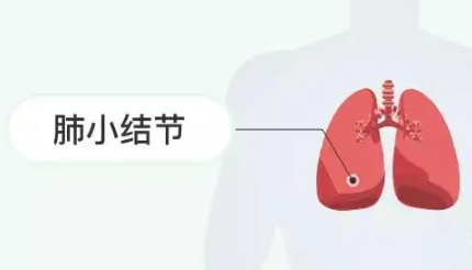 肺部小结节