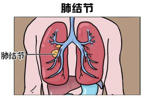 肺结节是什么意思 肺结节是什么意思