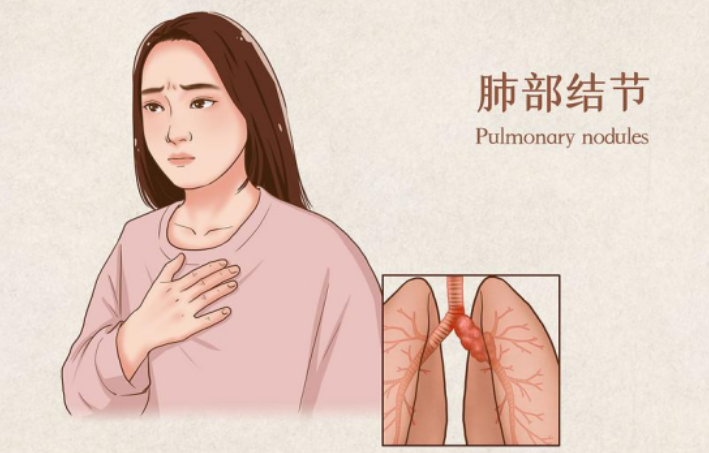 肺部结节 肺部结节
