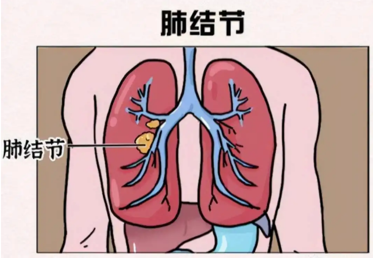 肺部结节最怕三个征兆 肺部结节最怕三个征兆