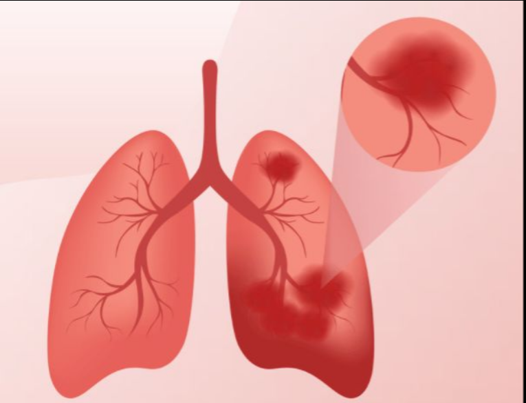 肺部结节形成原因
