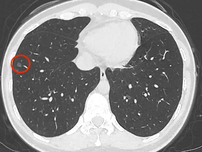 双肺有小结节