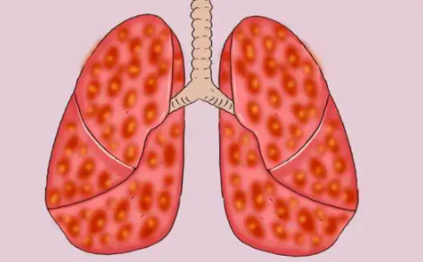 双肺有小结节