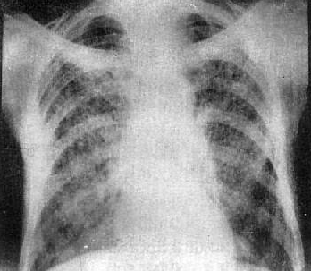 肺结节10个人9个人有吗