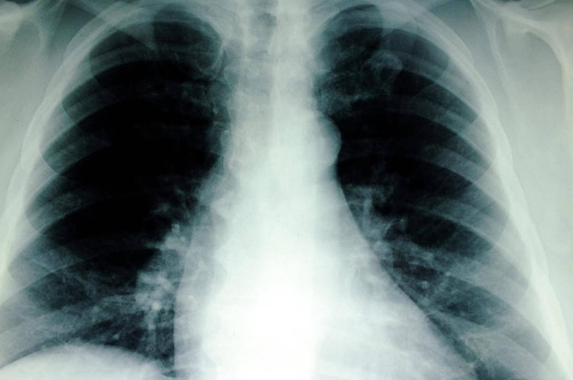 肺部结节需要治疗吗