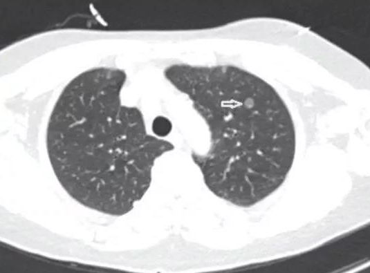 肺部有结节是怎么回事？要紧吗？