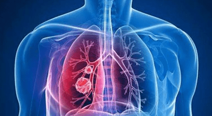 肺结节怎么治疗