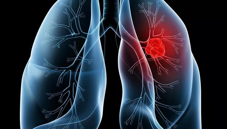 肺上结节80%是肺癌吗