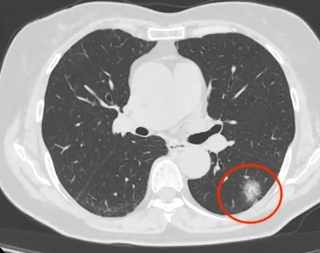 肺部结节