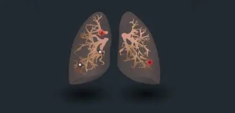 肺部结节需要治疗吗