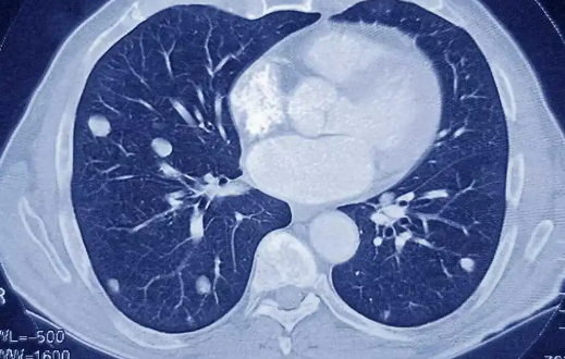 两肺多发小结节什么意思