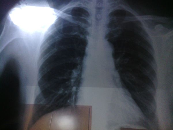 肺结节影