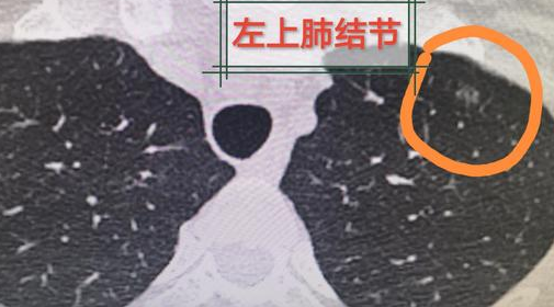 左肺上叶小结节 左肺上叶小结节