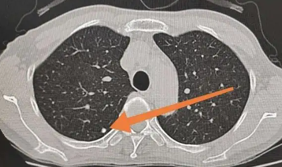 肺结节病 肺结节病