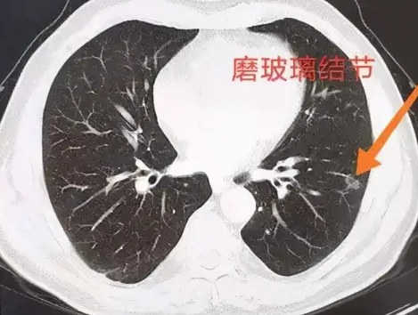 磨玻璃结节 磨玻璃结节