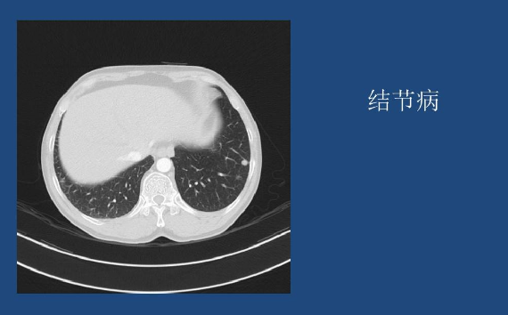 肺结节病 肺结节病