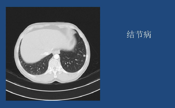 肺结节病