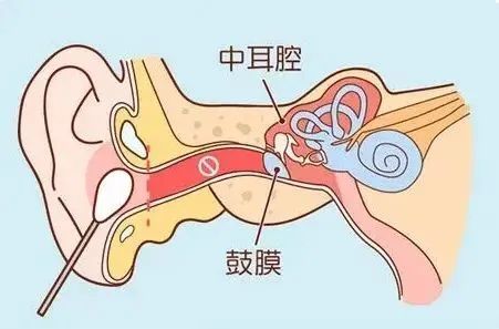 耳聋耳鸣 耳聋耳鸣