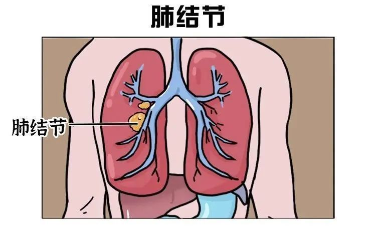 肺结节怎么治疗