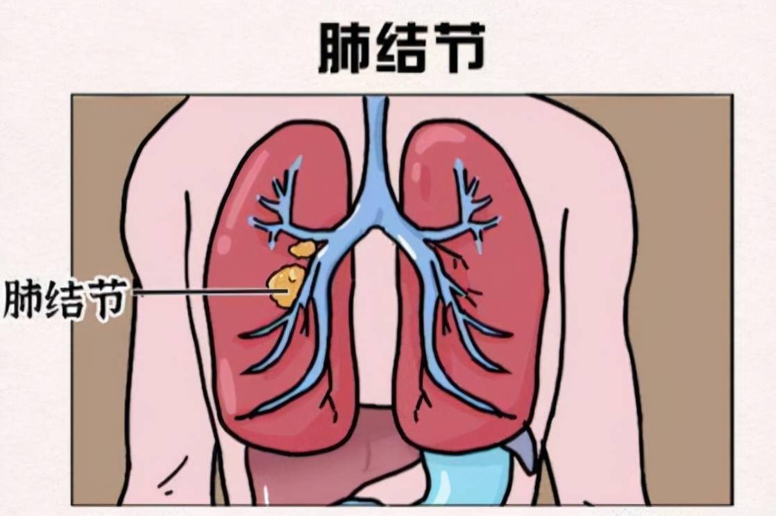 肺结节病 肺结节病