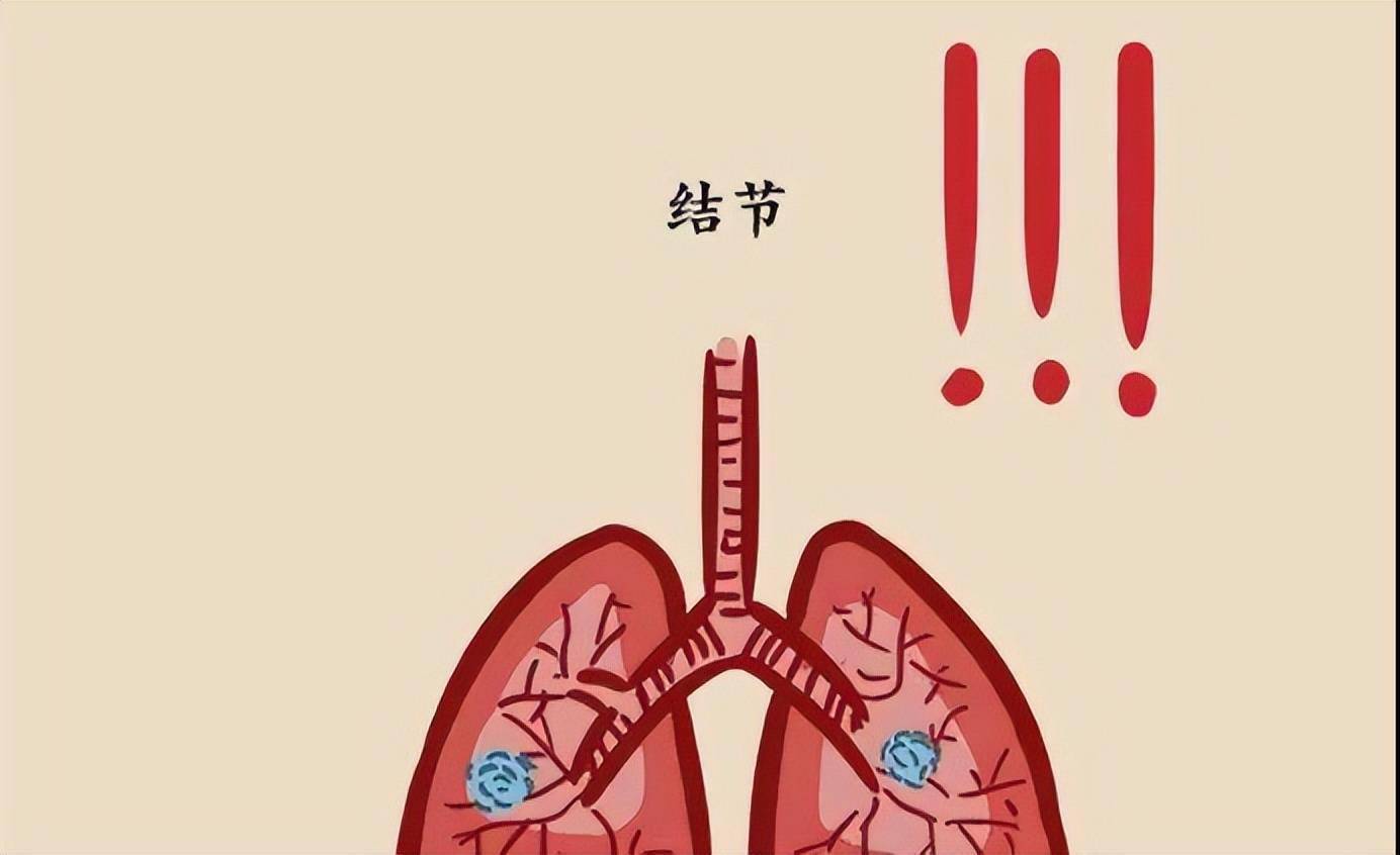 肺部结节 肺部结节