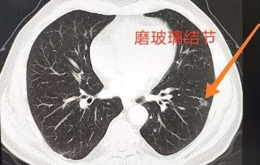 磨玻璃结节 磨玻璃结节