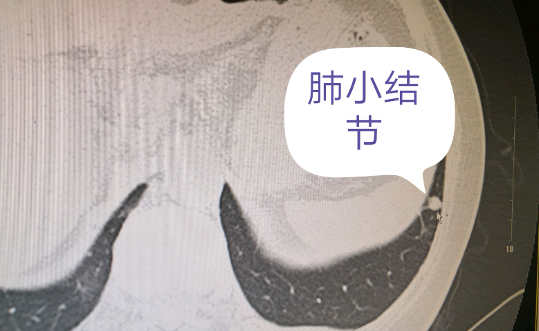肺部小结节