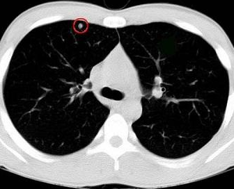 肺部小结节