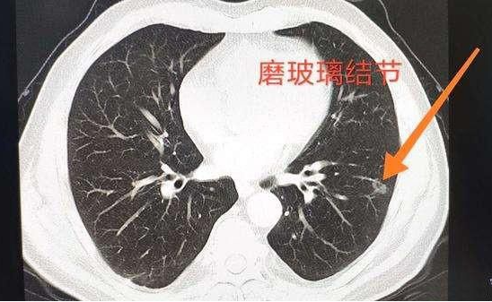 磨玻璃结节 磨玻璃结节