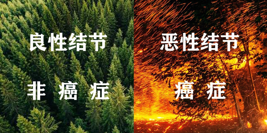 肺部结节 肺部结节