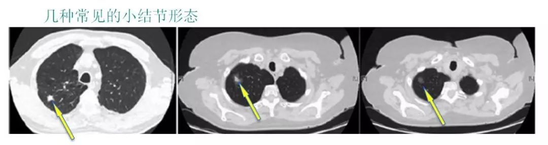 肺部小结节