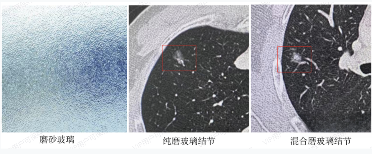 磨玻璃结节