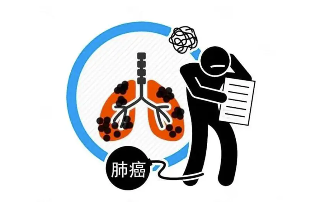 肺部结节 肺部结节