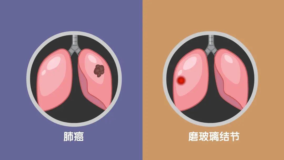 磨玻璃结节 磨玻璃结节