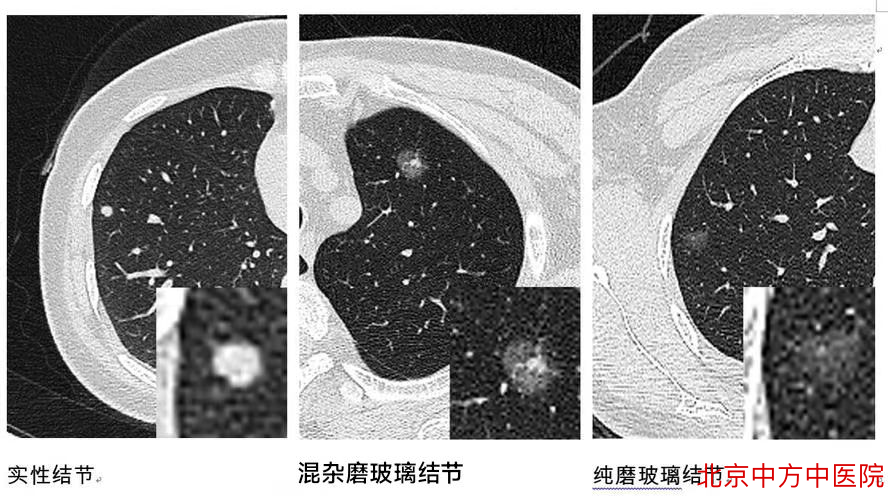 磨玻璃结节