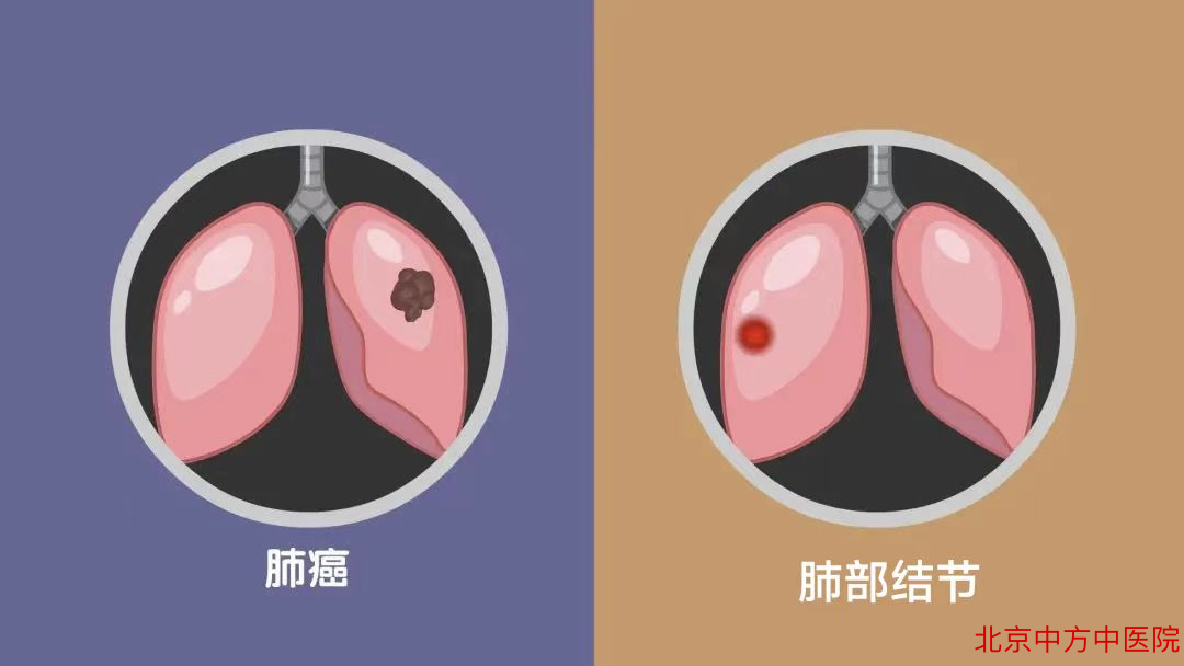 肺部结节 肺部结节
