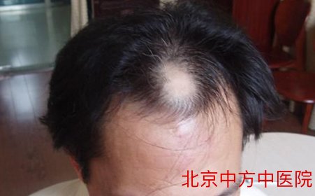 肾虚脱发 肾虚脱发