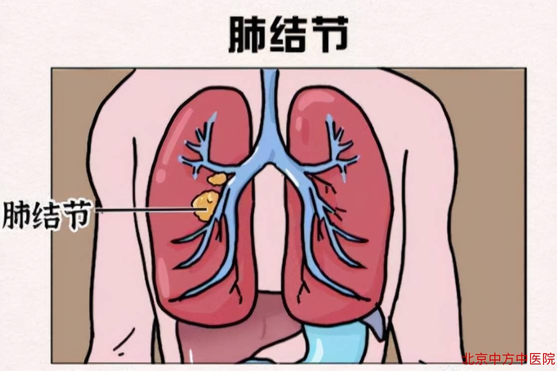 肺部结节 肺部结节