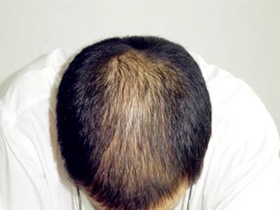肾虚脱发 肾虚脱发