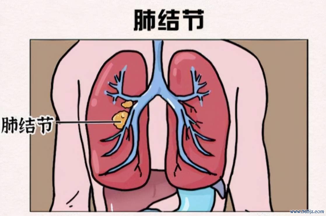 肺部结节 肺部结节