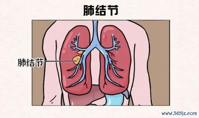 磨玻璃结节