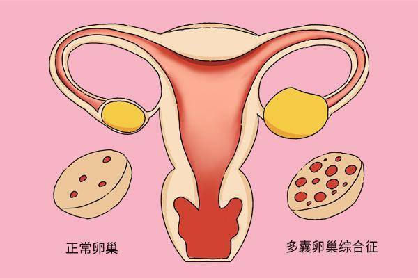 子宫内膜异位症 子宫内膜异位症