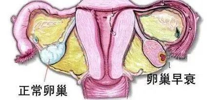 卵巢早衰 卵巢早衰