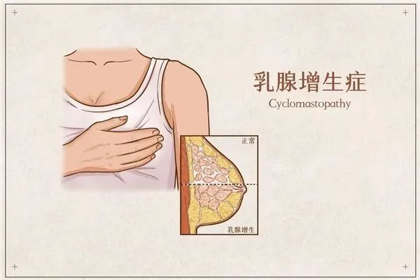 乳腺增生 乳腺增生