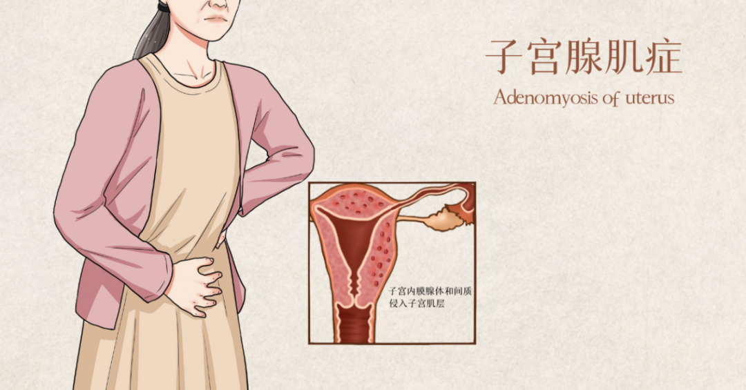 子宫腺肌症 子宫腺肌症