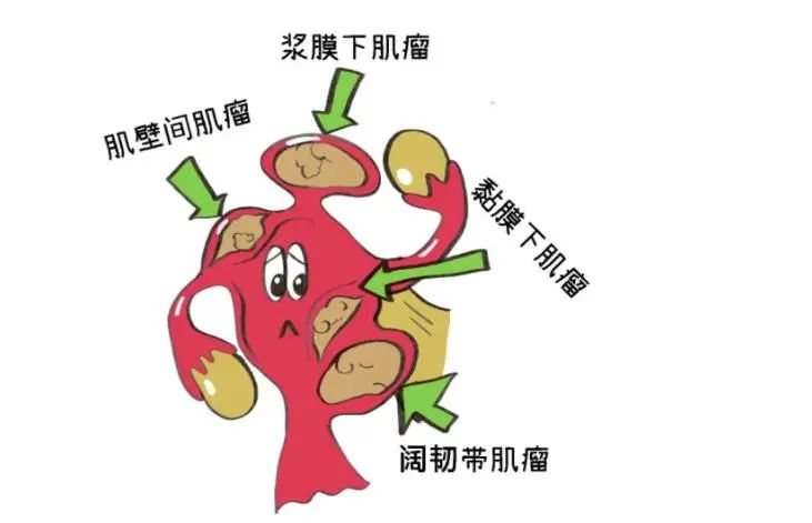 子宫肌瘤 子宫肌瘤