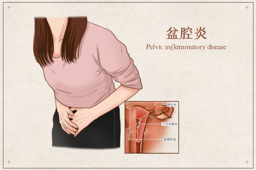 慢性盆腔炎 慢性盆腔炎